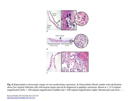 Fig. 4. Representative microscopic images of core needle biopsy specimens. A. Paucicellular fibrotic nodule with calcification shows few atypical follicular.