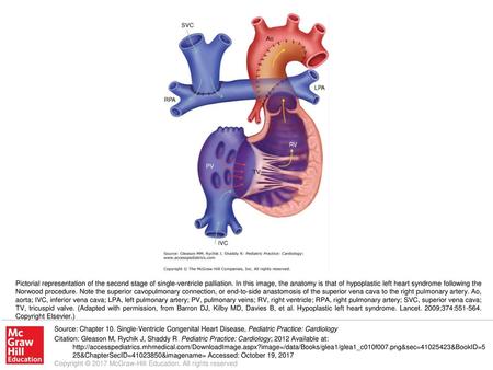 Pictorial representation of the second stage of single-ventricle palliation. In this image, the anatomy is that of hypoplastic left heart syndrome following.