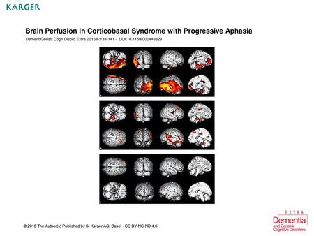 Brain Perfusion in Corticobasal Syndrome with Progressive Aphasia