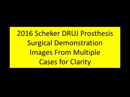 2016 Scheker DRUJ Prosthesis Surgical Demonstration Images From Multiple Cases for Clarity.