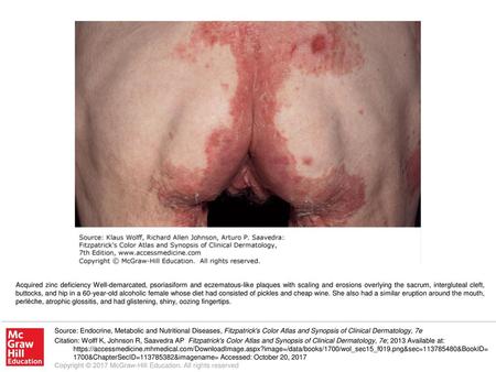 Acquired zinc deficiency Well-demarcated, psoriasiform and eczematous-like plaques with scaling and erosions overlying the sacrum, intergluteal cleft,