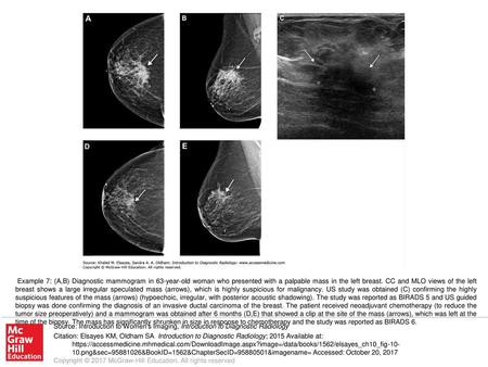 Example 7: (A,B) Diagnostic mammogram in 63-year-old woman who presented with a palpable mass in the left breast. CC and MLO views of the left breast shows.