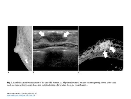 Fig. 1. Luminal A type breast cancer of 37-year-old woman. A