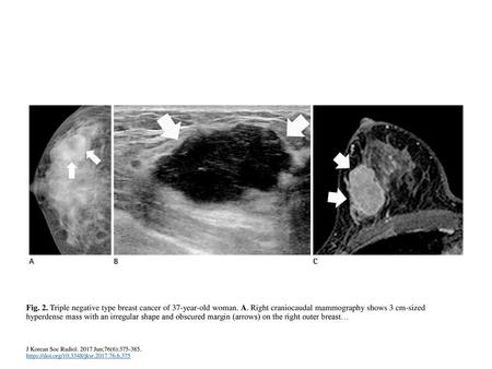 Fig. 2. Triple negative type breast cancer of 37-year-old woman. A