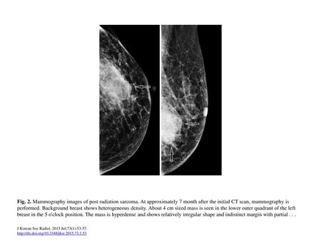 Fig. 2. Mammography images of post radiation sarcoma