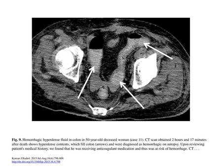 Fig. 9. Hemorrhagic hyperdense fluid in colon in 50-year-old deceased woman (case 11). CT scan obtained 2 hours and 17 minutes after death shows hyperdense.
