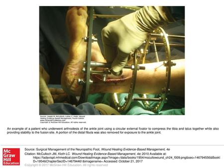 An example of a patient who underwent arthrodesis of the ankle joint using a circular external fixator to compress the tibia and talus together while also.