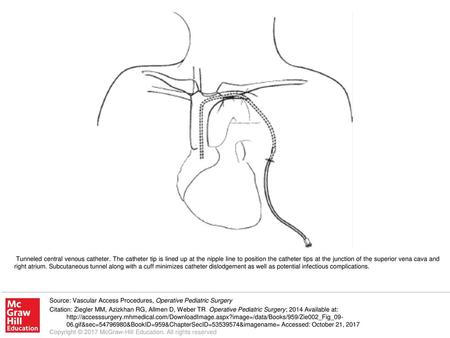 Tunneled central venous catheter
