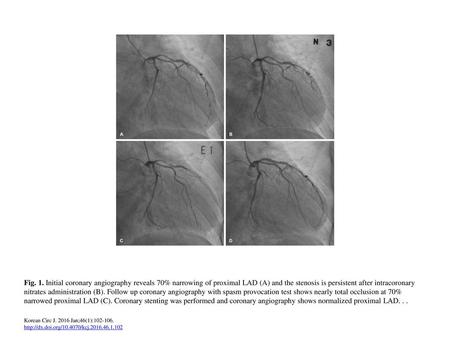 Fig. 1. Initial coronary angiography reveals 70% narrowing of proximal LAD (A) and the stenosis is persistent after intracoronary nitrates administration.