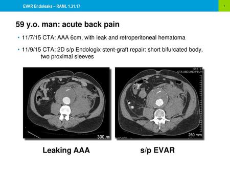 59 y.o. man: acute back pain Leaking AAA s/p EVAR