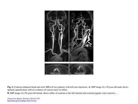 Fig. 2. Contrast-enhanced head and neck MRA of two patients with left-arm injections. A. MIP image of a 78-year-old male shows optimal opacification with.
