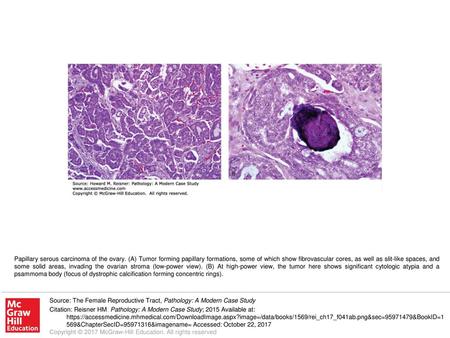 Papillary serous carcinoma of the ovary