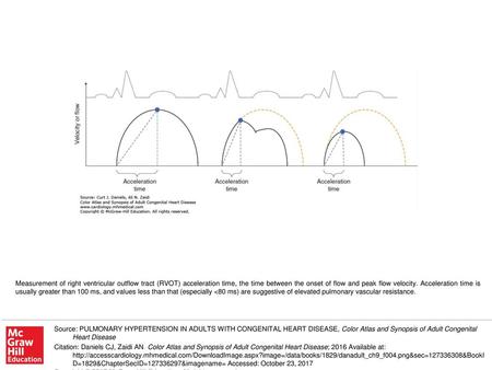 Measurement of right ventricular outflow tract (RVOT) acceleration time, the time between the onset of flow and peak flow velocity. Acceleration time is.