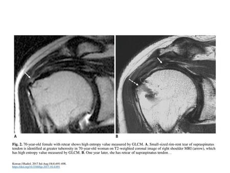 Fig. 2. 70-year-old female with retear shows high entropy value measured by GLCM. A. Small-sized rim-rent tear of supraspinatus tendon is identified at.