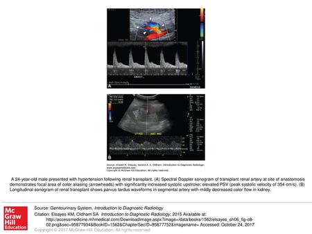 A 24-year-old male presented with hypertension following renal transplant. (A) Spectral Doppler sonogram of transplant renal artery at site of anastomosis.