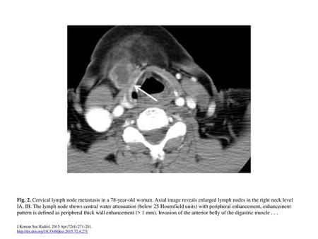 Fig. 2. Cervical lymph node metastasis in a 78-year-old woman