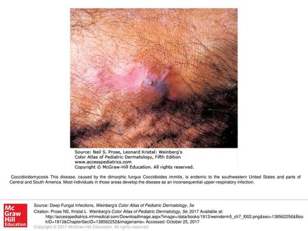Coccidioidomycosis This disease, caused by the dimorphic fungus Coccidioides immitis, is endemic to the southwestern United States and parts of Central.