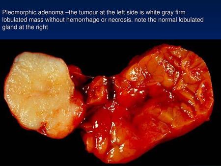Pleomorphic adenoma –the tumour at the left side is white gray firm lobulated mass without hemorrhage or necrosis. note the normal lobulated gland at the.