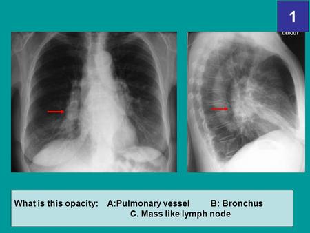 1 What is this opacity: A:Pulmonary vessel B: Bronchus
