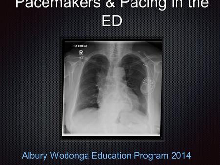 Pacemakers & Pacing in the ED Albury Wodonga Education Program 2014.