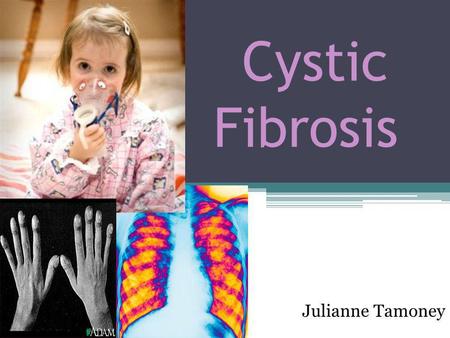 Cystic Fibrosis Julianne Tamoney. Objectives Brief discussion of pathophysiology Understand medical and nursing interventions Discussion of clinical relevance.