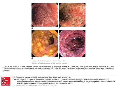 Causas de colitis. A. Colitis ulcerosa crónica con ulceraciones y exudados difusos. B. Colitis de Crohn grave, con úlceras profundas. C. Colitis seudomembranosa.