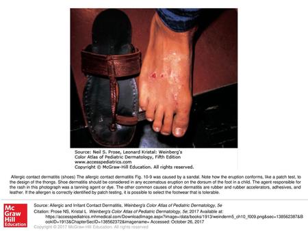 Allergic contact dermatitis (shoes) The allergic contact dermatitis Fig. 10-9 was caused by a sandal. Note how the eruption conforms, like a patch test,