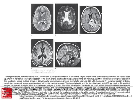 Montage of lesions demonstrated by MRI