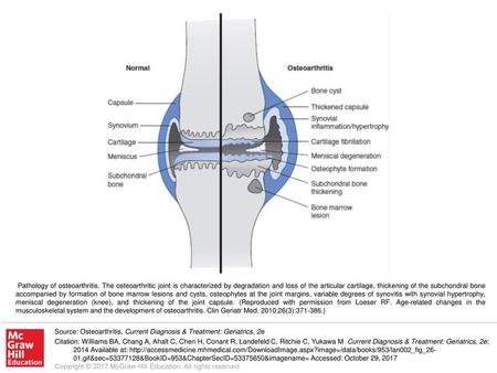 Pathology of osteoarthritis