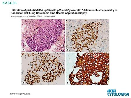 Utilization of p40 (ΔNp63) with p63 and Cytokeratin 5/6 Immunohistochemistry in Non-Small Cell Lung Carcinoma Fine-Needle Aspiration Biopsy Acta Cytologica.