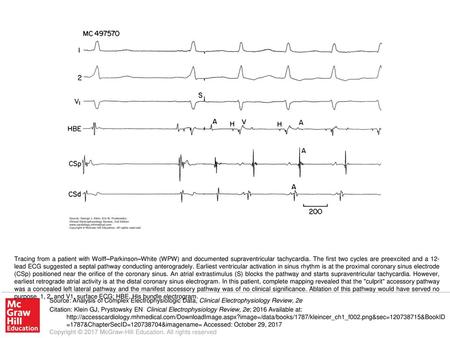 Tracing from a patient with Wolff–Parkinson–White (WPW) and documented supraventricular tachycardia. The first two cycles are preexcited and a 12-lead.