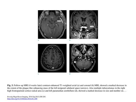 Fig. 3. Follow-up MRI (4 weeks later) contrast-enhanced T1-weighted axial (a) and coronal (b) MRI, showed a marked decrease in the extent of the plaque-like.