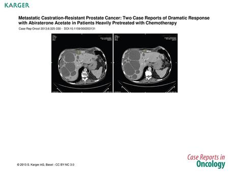 Metastatic Castration-Resistant Prostate Cancer: Two Case Reports of Dramatic Response with Abiraterone Acetate in Patients Heavily Pretreated with Chemotherapy.