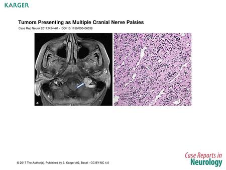 Tumors Presenting as Multiple Cranial Nerve Palsies