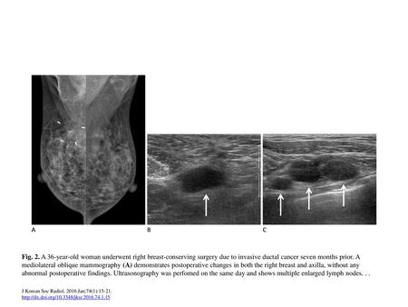 Fig. 2. A 36-year-old woman underwent right breast-conserving surgery due to invasive ductal cancer seven months prior. A mediolateral oblique mammography.
