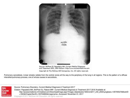 Pulmonary sarcoidosis