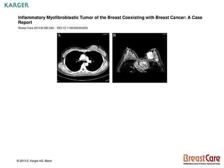 Inflammatory Myofibroblastic Tumor of the Breast Coexisting with Breast Cancer: A Case Report Breast Care 2013;8:290-292 - DOI:10.1159/000354250 Fig.
