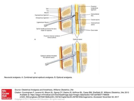 Neuraxial analgesia. A. Combined spinal-epidural analgesia. B