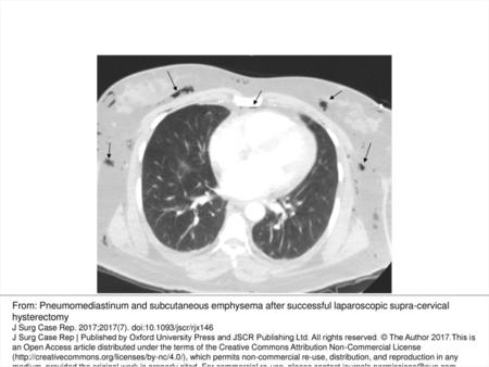 Figure 1: Pneumomediastinum and subcutaneous emphysema as indicated by the arrows. From: Pneumomediastinum and subcutaneous emphysema after successful.