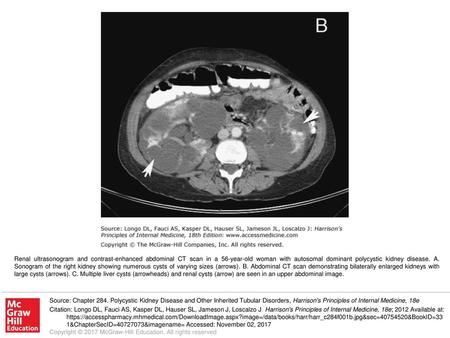 Renal ultrasonogram and contrast-enhanced abdominal CT scan in a 56-year-old woman with autosomal dominant polycystic kidney disease. A. Sonogram of the.