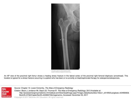 An AP view of the proximal right femur shows a healing stress fracture in the lateral cortex of the proximal right femoral diaphysis (arrowhead). This.