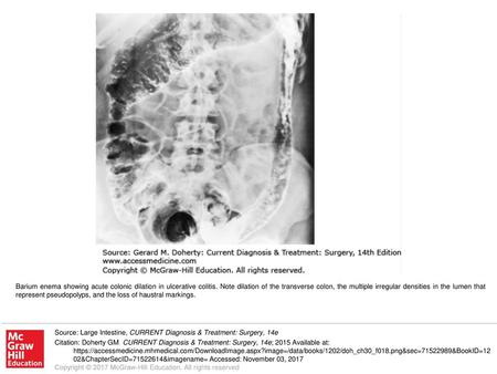 Barium enema showing acute colonic dilation in ulcerative colitis