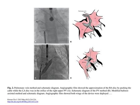 Fig. 2. Pulmonary vein method and schematic diagram