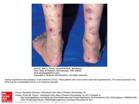 Hydroa vacciniforme-like cutaneous T-cell lymphoma (CTCL) These patients often have severe insect bite hypersensitivity. The lesions pictured in Fig. 24-23.