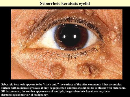 Seborrheic keratosis eyelid