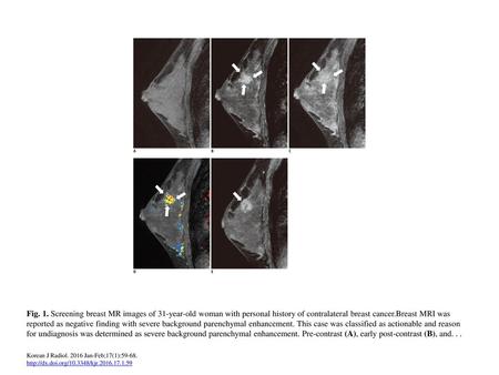 Fig. 1. Screening breast MR images of 31-year-old woman with personal history of contralateral breast cancer.Breast MRI was reported as negative finding.