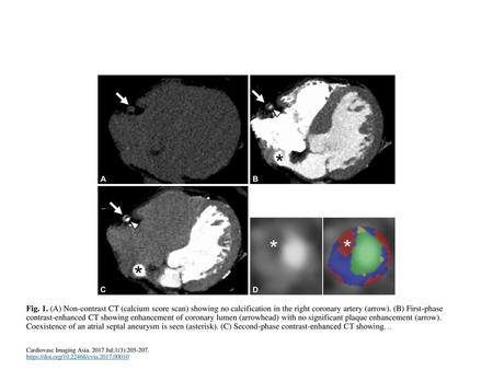 Fig. 1. (A) Non-contrast CT (calcium score scan) showing no calcification in the right coronary artery (arrow). (B) First-phase contrast-enhanced CT showing.