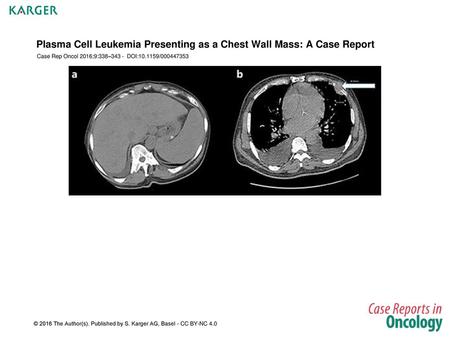 Plasma Cell Leukemia Presenting as a Chest Wall Mass: A Case Report