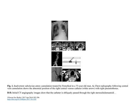 Fig. 1. Inadvertent subclavian artery cannulation treated by FemoSeal in a 73-year-old man. A. Chest radiography following central vein cannulation shows.