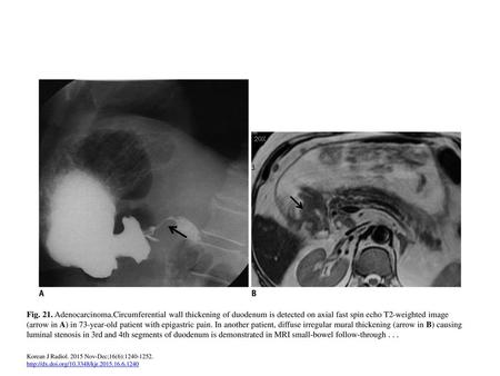 Fig. 21. Adenocarcinoma.Circumferential wall thickening of duodenum is detected on axial fast spin echo T2-weighted image (arrow in A) in 73-year-old patient.